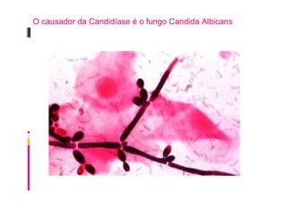 O causador da Candidíase é o fungo Candida Albicans
 