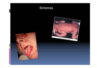 Sintomas
 