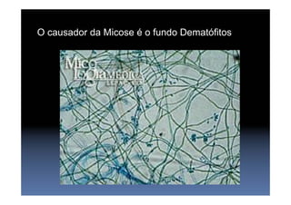 O causador da Micose é o fundo Dematófitos
 
