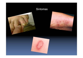 Sintomas
 