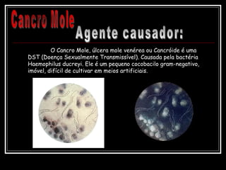 O Cancro Mole, úlcera mole venérea ou Cancróide é uma
DST (Doença Sexualmente Transmissível). Causada pela bactéria
Haemophilus ducreyi. Ele é um pequeno cocobacilo gram-negativo,
imóvel, difícil de cultivar em meios artificiais.
 