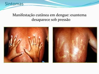 Sintomas
Manifestação cutânea em dengue: exantema              
desaparece sob pressão 
 