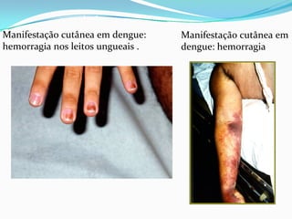 Manifestação cutânea em 
dengue: hemorragia 
Manifestação cutânea em dengue: 
hemorragia nos leitos ungueais .
 