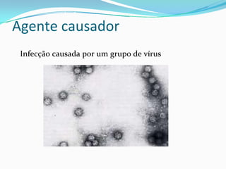 Agente causador 
Infecção causada por um grupo de vírus 
 