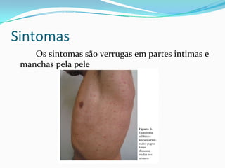 Sintomas 
Os sintomas são verrugas em partes intimas e 
manchas pela pele
 
