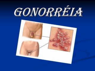 GONORRGONORRÉÉIAIA
 