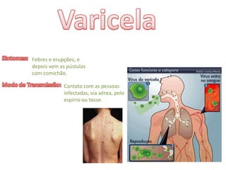 Febres e erupções, e 
depois vem as pústulas 
com comichão.
Contato com as pessoas 
infectadas, via aérea, pelo 
espirro ou tosse.
 