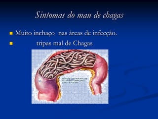 Sintomas do mau de chagasSintomas do mau de chagas
Muito inchaMuito inchaçço naso nas ááreas de infecreas de infecçção.ão.
tripas mal de Chagastripas mal de Chagas
 