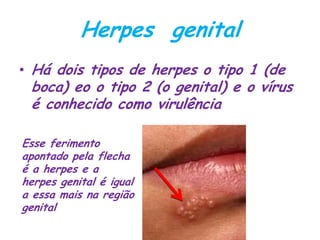 Herpes genital
• Há dois tipos de herpes o tipo 1 (de
boca) eo o tipo 2 (o genital) e o vírus
é conhecido como virulência
Esse ferimento
apontado pela flecha
é a herpes e a
herpes genital é igual
a essa mais na região
genital
 