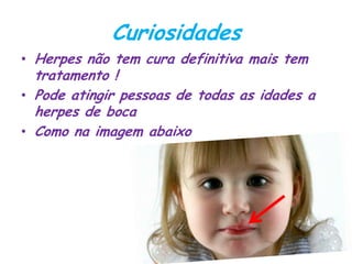 Curiosidades
• Herpes não tem cura definitiva mais tem
tratamento !
• Pode atingir pessoas de todas as idades a
herpes de boca
• Como na imagem abaixo
 