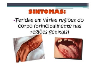 •Feridas em várias regiões do
corpo (principalmente nas
regiões genitais)
 