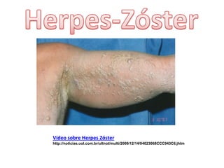 Vídeo sobre Herpes Zóster
http://noticias.uol.com.br/ultnot/multi/2009/12/14/04023068CCC943C6.jhtm
 