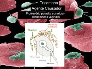 Tricomona
Agente Causador
Protozoário parasita eucariota -
Trichomonas vaginalis
 