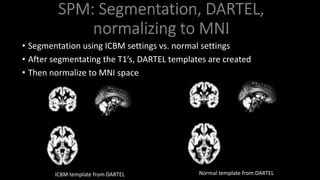 • Segmentation using ICBM settings vs. normal settings
• After segmentating the T1’s, DARTEL templates are created
• Then normalize to MNI space
ICBM template from DARTEL Normal template from DARTEL
 