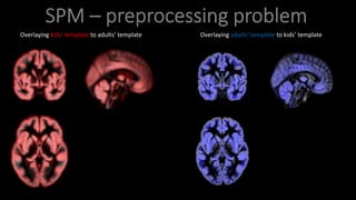 Overlaying kids’ template to adults’ template
We see overestimation all
around the brain
Overlaying adults’ template to kids’ template
We see underestimation all
around the brain
 
