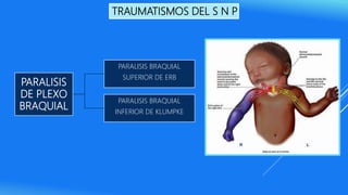 TRAUMATISMOS DEL S N P
PARALISIS
DE PLEXO
BRAQUIAL
PARALISIS BRAQUIAL
SUPERIOR DE ERB
PARALISIS BRAQUIAL
INFERIOR DE KLUMPKE
 
