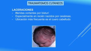 LACERACIONES
- Heridas cortantes por bisturí
- Especialmente en recién nacidos por cesáreas.
- Ubicación más frecuente es el cuero cabelludo
TRAUMATISMOS CUTANEOS
 