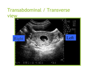 Transabdominal / Transverse
view
Right Left
 