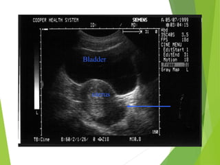 Bladder
uterus
 