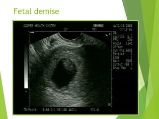 Fetal demise
 