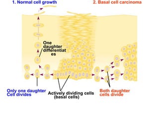 1. Normal cell growth 2. Basal cell carcinoma
Both daughter
cells divide
Actively dividing cells
(basal cells)
Only one daughter
Cell divides
One
daughter
differentiat
es
 