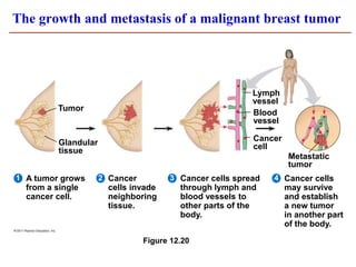 Figure 12.20
Glandular
tissue
Tumor
Lymph
vessel
Blood
vessel
Cancer
cell
Metastatic
tumor
A tumor grows
from a single
cancer cell.
Cancer
cells invade
neighboring
tissue.
Cancer cells spread
through lymph and
blood vessels to
other parts of the
body.
Cancer cells
may survive
and establish
a new tumor
in another part
of the body.
4
3
2
1
The growth and metastasis of a malignant breast tumor
 