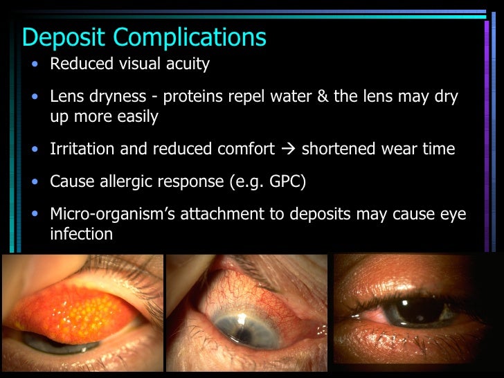 care and maintenance of soft contact lenses