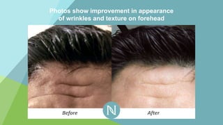 Photos show improvement in appearance
of wrinkles and texture on forehead
Before After
 