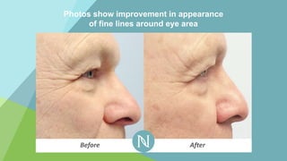 Photos show improvement in appearance
of fine lines around eye area
Before After
 