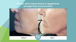 Photos show improvement in appearance
of laugh lines around mouth
Before After
 