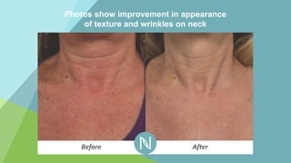 Photos show improvement in appearance
of texture and wrinkles on neck
Before After
 