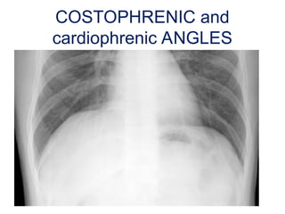 Respiratory medicine dept Chest X-Ray.ppt