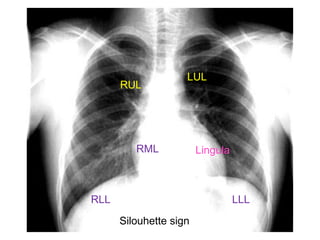 Respiratory medicine dept Chest X-Ray.ppt