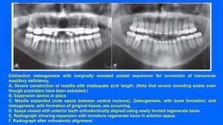 Lecture 7 correction of dentofacial deformities Part 2 | PPTX