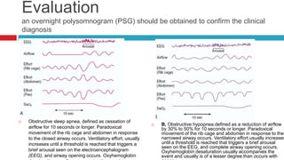 Evaluation
an overnight polysomnogram (PSG) should be obtained to confirm the clinical
diagnosis
 Obstructive sleep apnea. defined as cessation of
airflow for 10 seconds or longer. Paradoxical
movement of the rib cage and abdomen in response
to the closed airway occurs. Ventilatory effort, usually
increases until a threshold is reached that triggers a
brief arousal seen on the electroencephalogram
(EEG), and airway opening occurs. Oxyhemoglobin
 B, Obstructive hypopnea.defined as a reduction of airflow
by 30% to 50% for 10 seconds or longer. Paradoxical
movement of the rib cage and abdomen in response to the
narrowed airway occurs. Ventilatory effort usually increases
until a threshold is reached that triggers a brief arousal
seen on the EEG, and complete airway opening occurs.
Oxyhemoglobin desaturation usually accompanies the
event and usually is of a lesser degree than occurs with
 