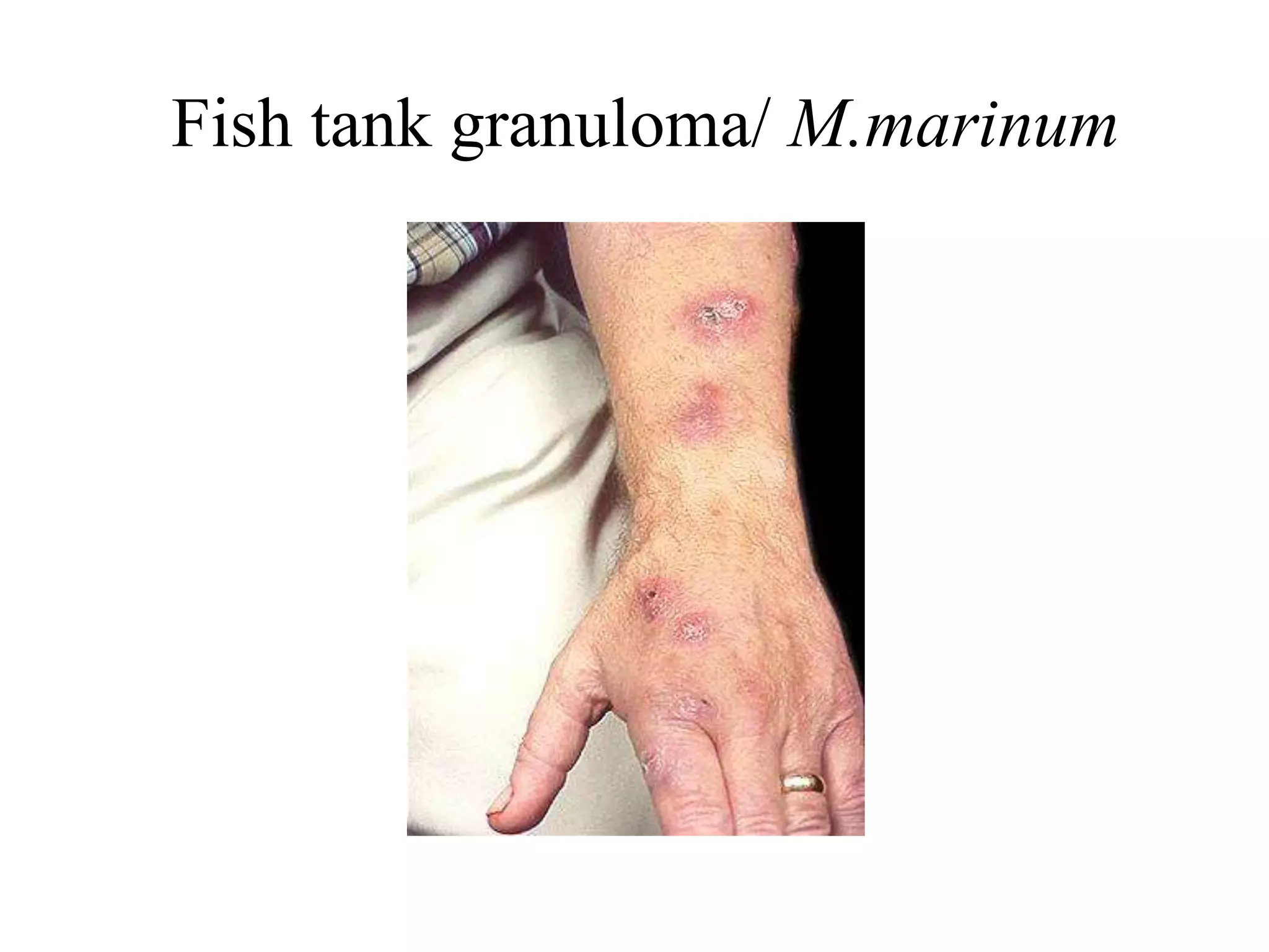 Fish tank granuloma/ M.marinum
 