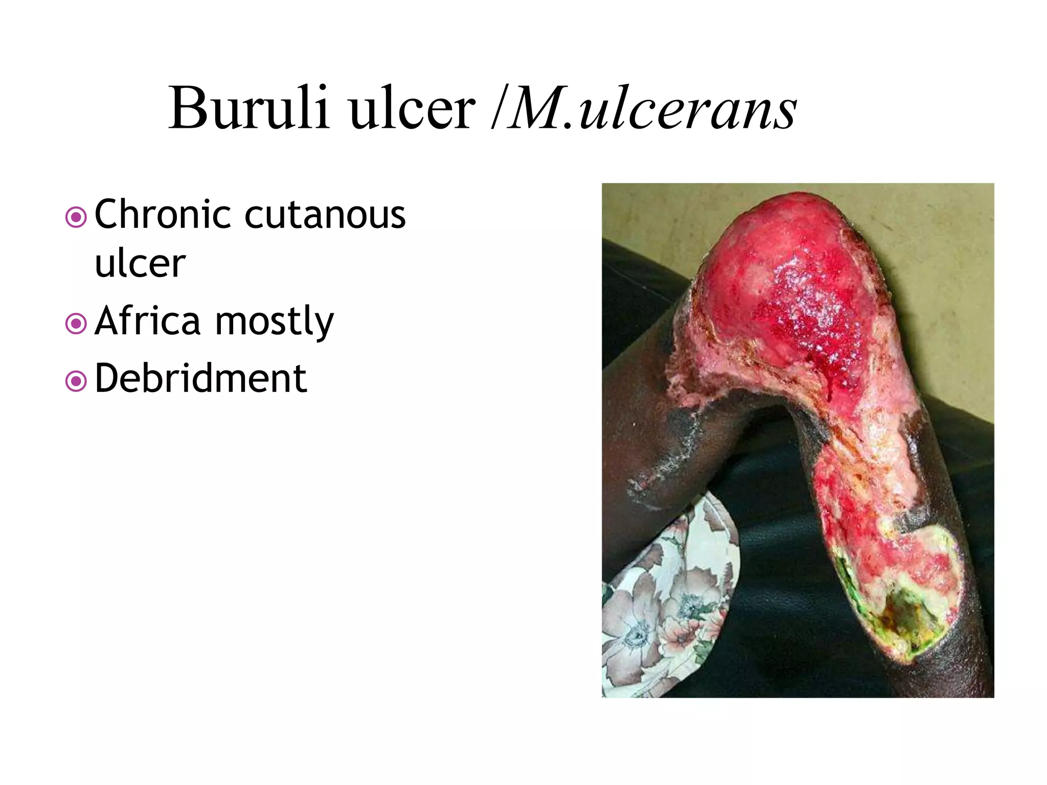 Buruli ulcer /M.ulcerans
 Chronic cutanous
ulcer
 Africa mostly
 Debridment
 