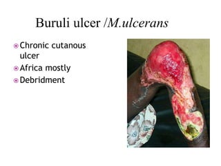 Buruli ulcer /M.ulcerans
 Chronic cutanous
ulcer
 Africa mostly
 Debridment
 