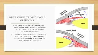 Glaucoma | PDF