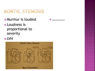  Murmur is loudest
 Loudness is
proportional to
severity
 LVH
 ……………
 