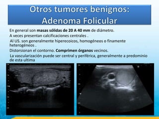 En general son masas sólidas de 20 A 40 mm de diámetro.
A veces presentan calcificaciones centrales .
Al US. son generalmente hiperecoicos, homogéneos o finamente
heterogéneos .
Distorsionan el contorno. Comprimen órganos vecinos.
La vascularización puede ser central y periférica, generalmente a predominio
de esta ultima
 