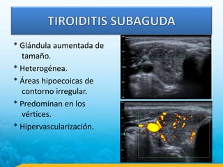 * Glándula aumentada de
tamaño.
* Heterogénea.
* Áreas hipoecoicas de
contorno irregular.
* Predominan en los
vértices.
* Hipervascularización.
 