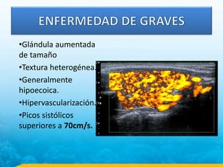 •Glándula aumentada
de tamaño
•Textura heterogénea.
•Generalmente
hipoecoica.
•Hipervascularización.
•Picos sistólicos
superiores a 70cm/s.
 