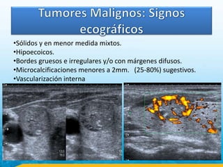 •Sólidos y en menor medida mixtos.
•Hipoecoicos.
•Bordes gruesos e irregulares y/o con márgenes difusos.
•Microcalcificaciones menores a 2mm. (25-80%) sugestivos.
•Vascularización interna
 