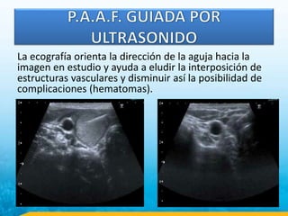 La ecografía orienta la dirección de la aguja hacia la
imagen en estudio y ayuda a eludir la interposición de
estructuras vasculares y disminuir así la posibilidad de
complicaciones (hematomas).
 
