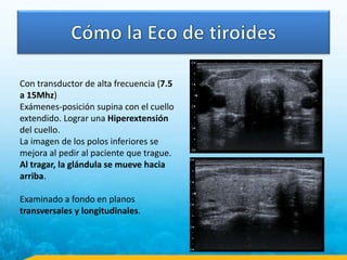 Con transductor de alta frecuencia (7.5
a 15Mhz)
Exámenes-posición supina con el cuello
extendido. Lograr una Hiperextensión
del cuello.
La imagen de los polos inferiores se
mejora al pedir al paciente que trague.
Al tragar, la glándula se mueve hacia
arriba.
Examinado a fondo en planos
transversales y longitudinales.
 