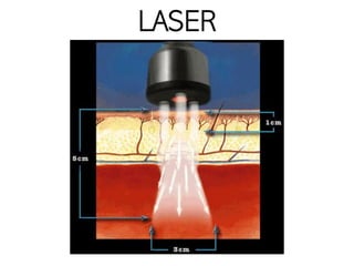 LASER
 