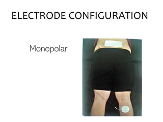 ELECTRODE CONFIGURATION
Monopolar
 