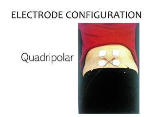 Quadripolar
ELECTRODE CONFIGURATION
 