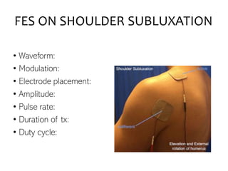 FES ON SHOULDER SUBLUXATION
• Waveform:
• Modulation:
• Electrode placement:
• Amplitude:
• Pulse rate:
• Duration of tx:
• Duty cycle:
 